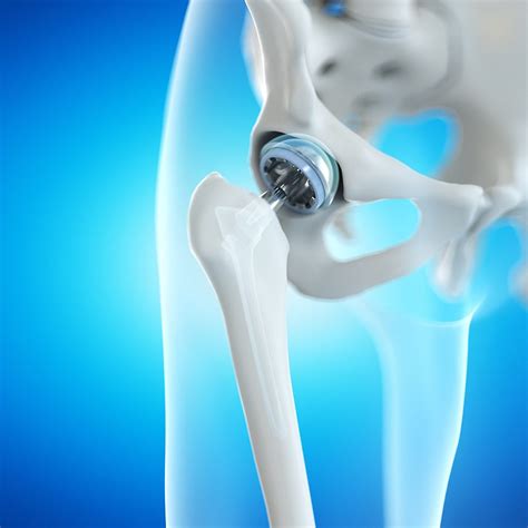 Anterior Vs Posterior Hip Replacement A Comparative Analysis Southern Utah Orthopaedic