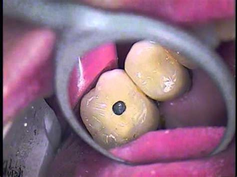 So how do dentists fix loose teeth? 1. Loose Dental Implant screw - Implant supported crown ...