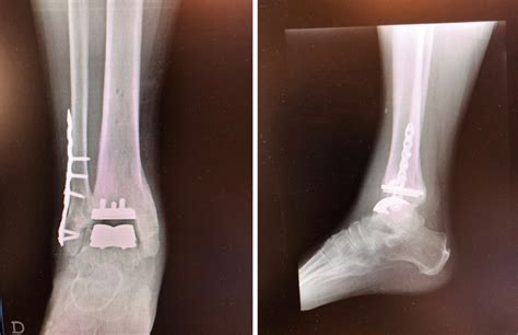 Protesi Di Caviglia Dott Gianluca Falcone