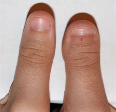 Pictures Of Clubbed Thumbs