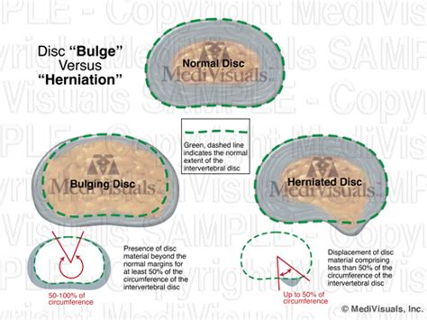 How A Disc Bulge Is Different From A Herniation Intervertebral
