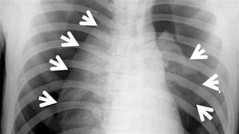 Intubation) can convert an occult pneumothorax to a tension pneumothorax. Pneumothorax: Types, Causes, Symptoms, and Treatment