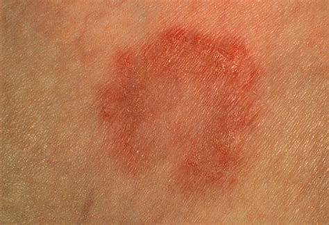 Tinea Corporis Ringworm Lesion On Skin Bild Kaufen 11843293