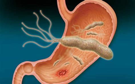 Helicobacter Pylori Sintomas ⊛ ¡prevención Y Tratamiento 2020