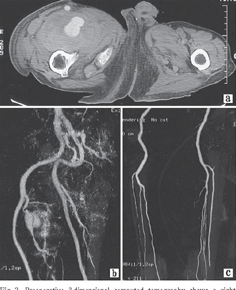 Figure 1 From Surgical Management Of A Deep Femoral Artery Aneurysm