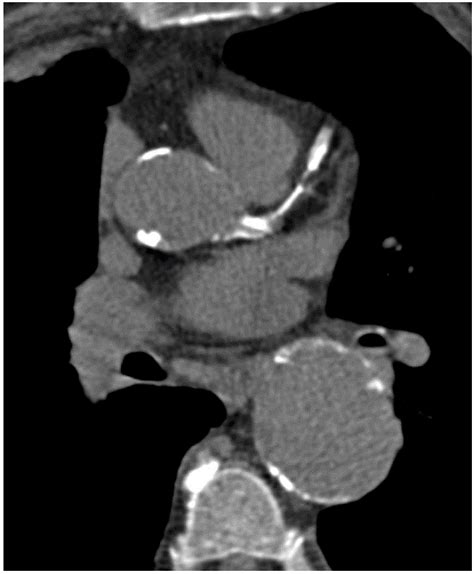 Ijms Free Full Text Coronary Ct Angiography In Managing Atherosclerosis