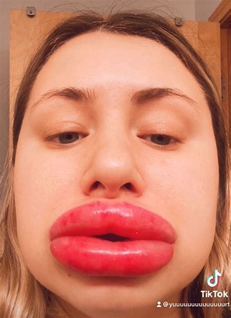 My Lips Ballooned To Eight Times Their Normal Size After I Had Filler Lips Lip Trends Fake Lips
