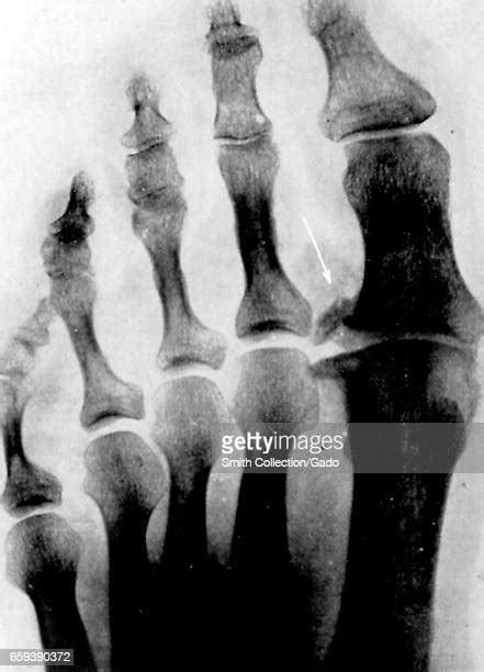Big Toe Arthritis Photos And Premium High Res Pictures Getty Images