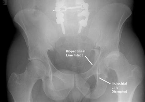 Posterior Column Acetabular Fracture