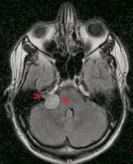 It is important to keep an eye on it is important to keep an eye on your cat's behaviors and be aware of any noticeable lumps or growths. Aspirin Slows Brain Tumor Growth (Acoustic Neuroma ...