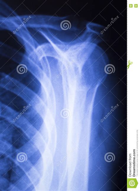 Shoulder Joint Orthopedic Xray Scan Stock Image Image Of Limb