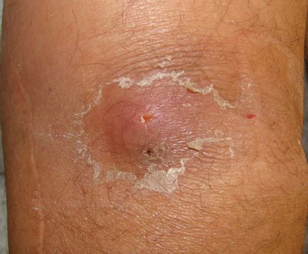 This particular symptom tends to happen as acute or chronic leukemia progresses, when the white blood cells, or neoplastic leukocytes, that are found in the bone marrow start to filter into the. MKSAP Quiz: 5-day history of asymptomatic rash | ACP Internist