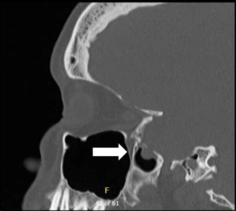 Repairing Lateral Sphenoid Cerebrospinal Fluid Leaks Endoscopically