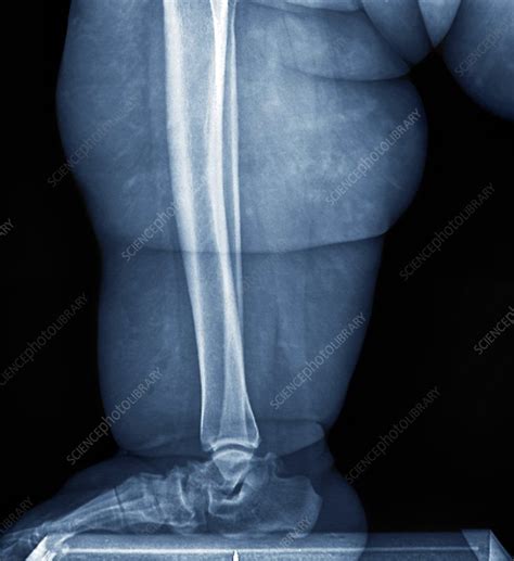 Obesity X Ray Stock Image C0211901 Science Photo Library