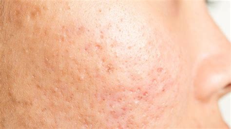 What You Dont Know About Pimples Pimples Prevent Breakouts Beauty
