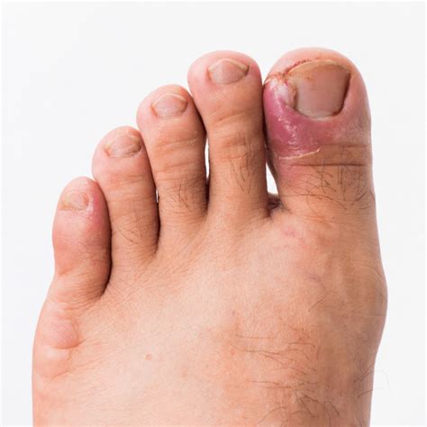Why Do Ingrown Toenails Keep Coming Back Weve Got Your Permanent