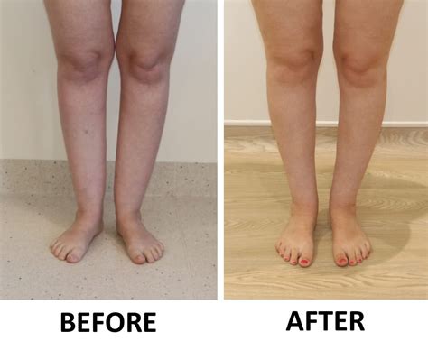 Ankle Cankle Contouring The Karri Clinic