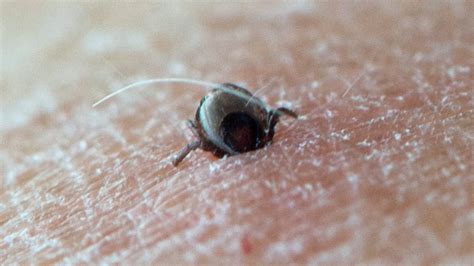 What Is Lyme Disease Itv News Granada