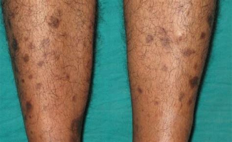 Hi ,i have dark black spots on my feet which goes upto the ankle.it does not itch but is very embarising as it is dam visible when contacted my skin doctor he said use the medicine provided if you don't scratch, the dark spots will disappear soon, so the problem is how to stop scratching now. Brown Spots on Legs, Lower Legs, Get Rid of Little Light ...