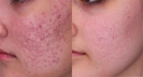 Professional Red Acne Scars Treatment Brisban Cutis Dermatology