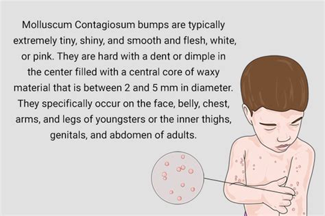 Molluscum Contagiosum Causes Symptoms And Treatment