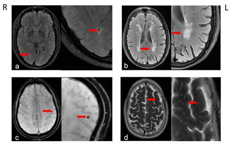 Jcm Free Full Text Total Burden Of Cerebral Small Vessel Disease On