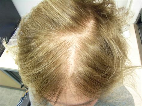 The Hair Loss Centre Female Hair LossBEFORE