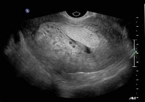 Ultrasound Case Of The Month Hydatidiform Mole BROWN EMERGENCY MEDICINE