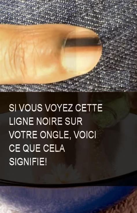 What does tache noire mean? Si vous voyez cette ligne noire sur votre ongle, voici ce ...