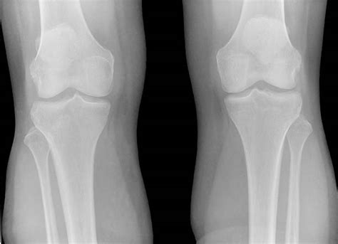 Normal Knee X Ray Stock Photos Pictures And Royalty Free Images Istock