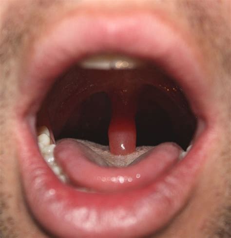 My Experience With Uvulitis Not Fun Patients Lounge