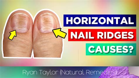 Horizontal Ridges On Nails Cause Youtube
