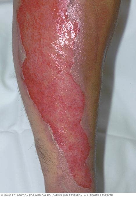 Health care professionals encounter burns in their patient populations frequently, and must be able to differentiate between types of burns, as well as know how to treat burn injuries using current practice standards. Second-degree burn - Mayo Clinic