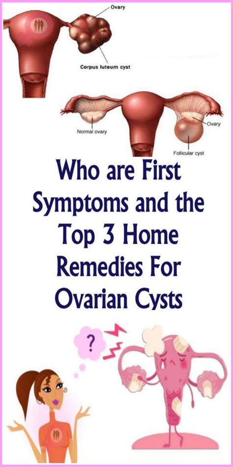 Who Are First Symptoms And The Top 3 Home Remedies For Ovarian Cysts