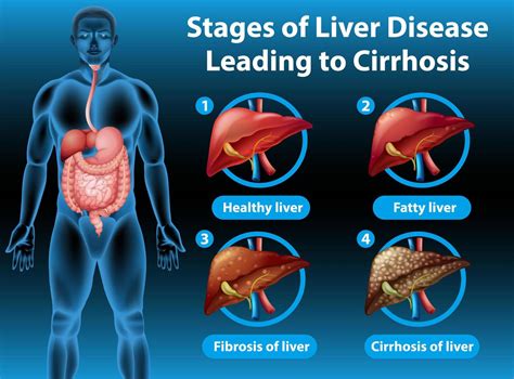 Liver Cirrhosis Stages