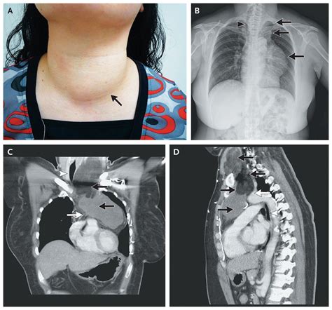 Liposarcoma Of The Anterior Mediastinum And Neck Nejm