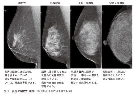 Frq1 マンモグラフィの乳房構成の判定に自動測定ソフトを用いることは有用か？ 検診・画像診断 乳癌診療ガイドライン2022年版