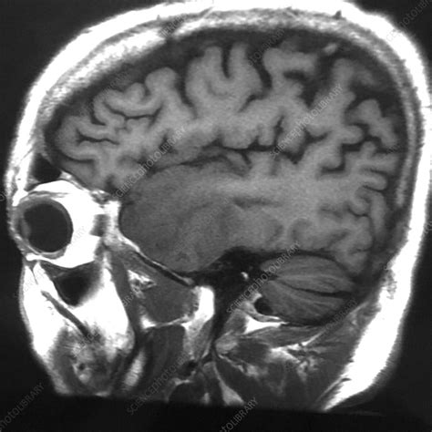 Anaplastic Astrocytoma Of Temporal Lobe Mri Stock Image C0394039