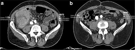 Extraordinary Disease Free Survival In A Rare Malignant Extrarenal