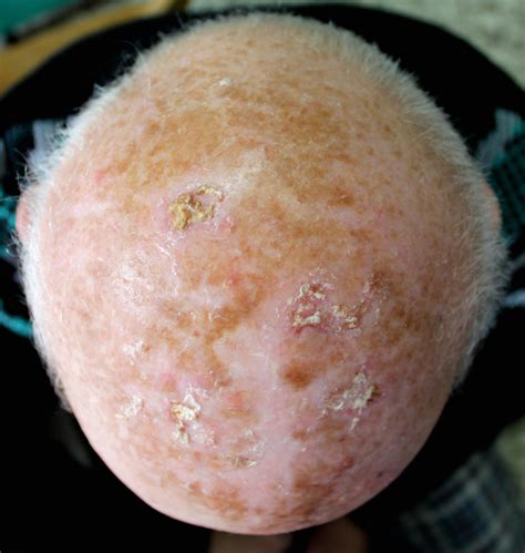 Actinic Keratosis Appearance Vs Squamous Cell Carcinoma Scary Symptoms