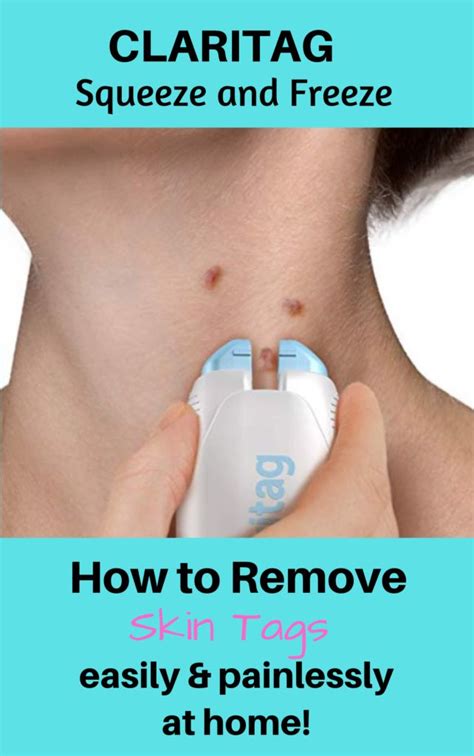 Most doctors recommend removal of skin tags only when they are irritated or a source of discomfort, or if they constitute a cosmetic problem. CLARITAG Squeeze and Freeze Skin Tag Removal Device ...