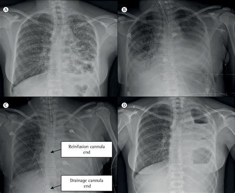 Chest X Rays Showing The Progression Of The Patient In A Chest X Ray