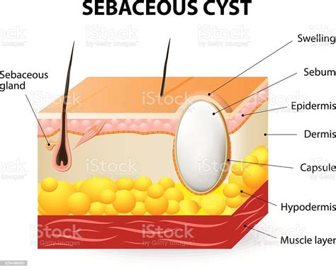 Sebaceous Cyst Or Trichilemmal Cyst Stock Illustration Download Image