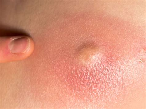 Learn more from webmd about boils, a skin infection, including their symptoms and treatment. Cyst vs. boil: Identification, symptoms, causes, and ...