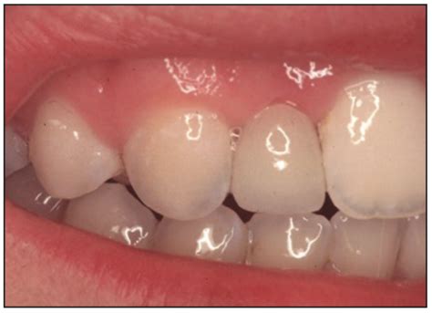 Minimally Invasive Bonded Bridges Vs Implants Dentistry Today