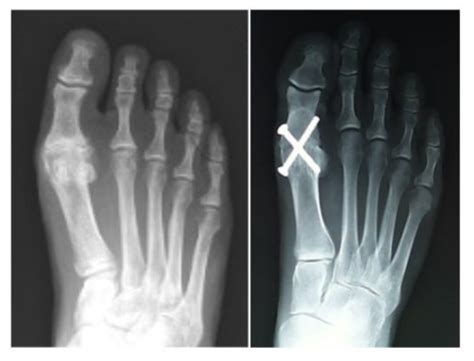 Great Toe Arthritis Hallux Rigidus Dr Hamish Curry Foot And Ankle