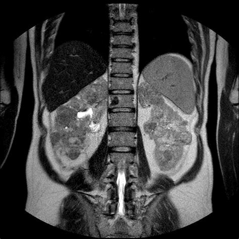 Cbr Bradcases Sangramento De Angiomiolipoma Em Paciente Com Esclerose Tuberosa