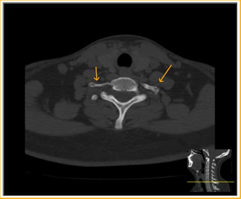 Cervical Ribs Ct Radiology Imaging