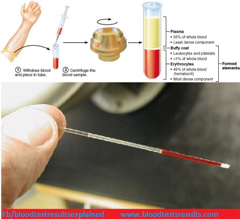 What Is Hematocrit Hct In Cbc Test Results Blood Test Results