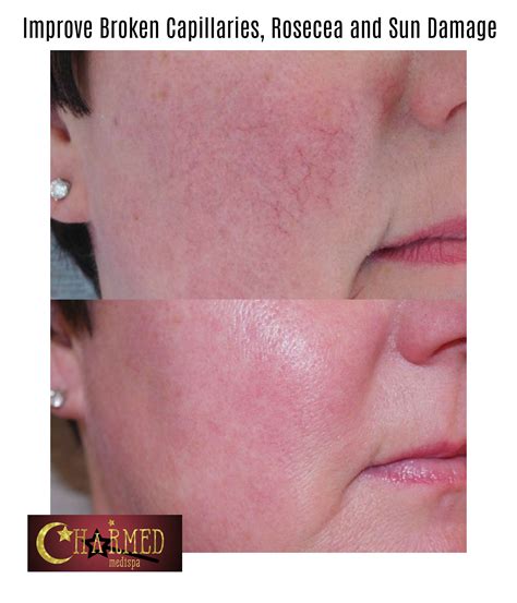 Broken Capillaries Redness And Rosecea Dramatically Improved Charmed